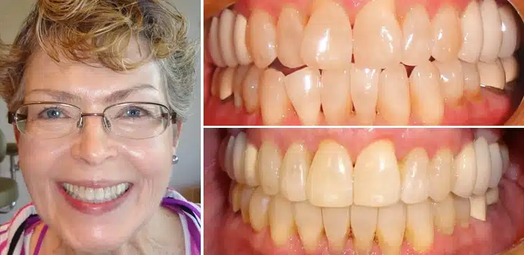 A real case study of a woman who straghtened her teeth with Invisalign by Dr. Mike Hinkle the best dentist in Oklahoma