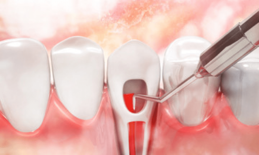 Know all about root canal therapy.