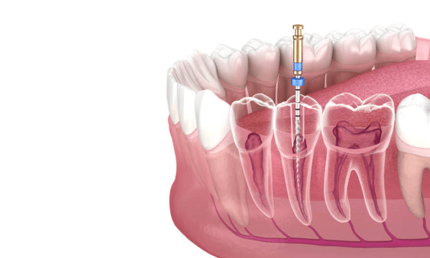 What Is All Involved In Root Canal Therapy in Tulsa Utica Dental of Tulsa