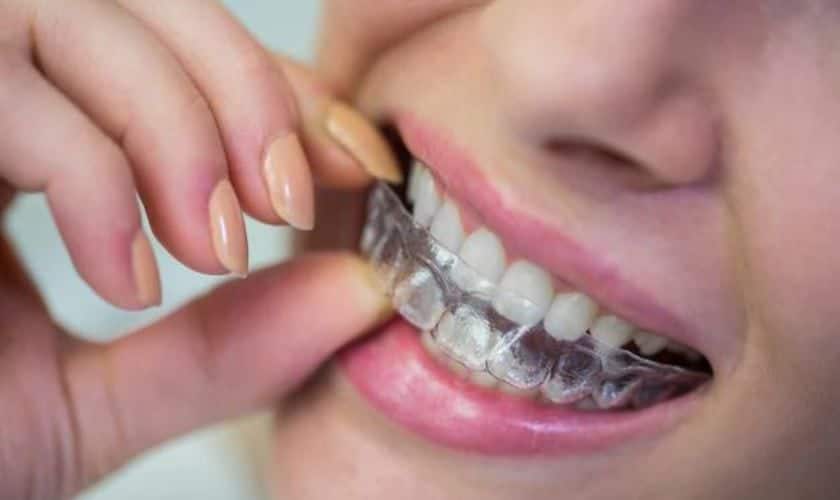 Know About Invisalign Clear Aligners In Detail