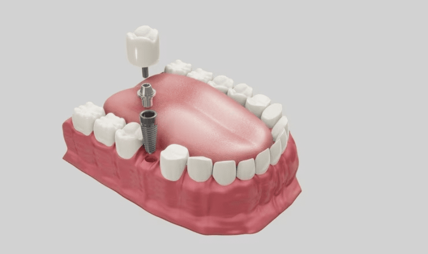 Dental Implants: A Guide To this Amazing Treatment