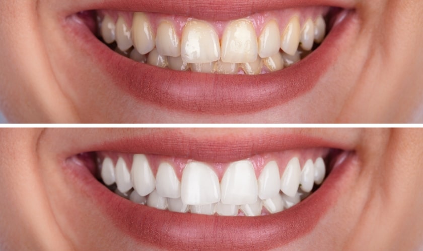 10 Surprising Facts About Teeth Whitening You Need to Know