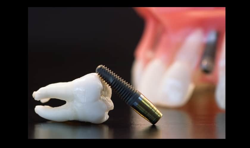 A model of dental implant