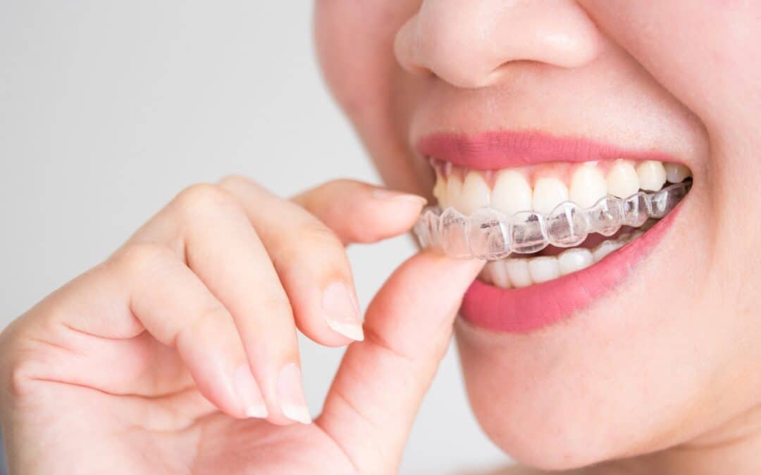 Invisalign