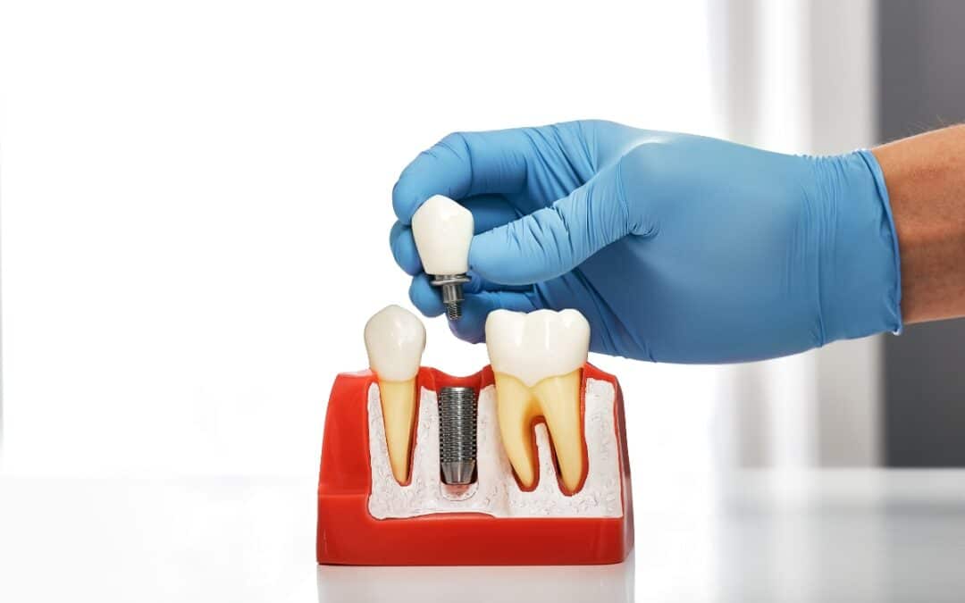 dental implants model