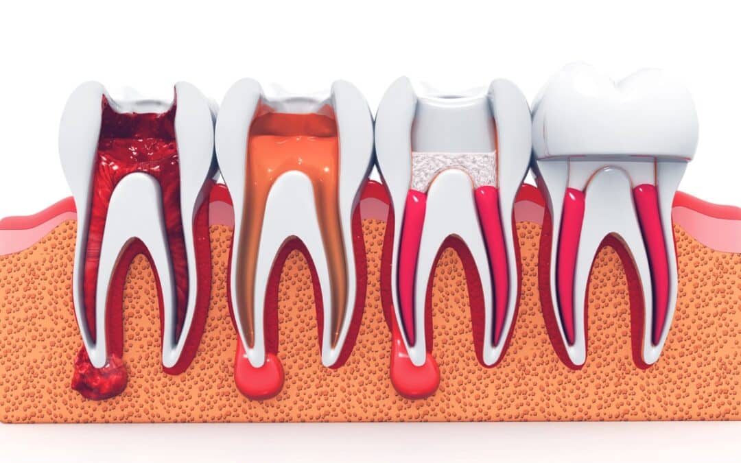Is Nitrous Oxide Safe During Root Canal Therapy?