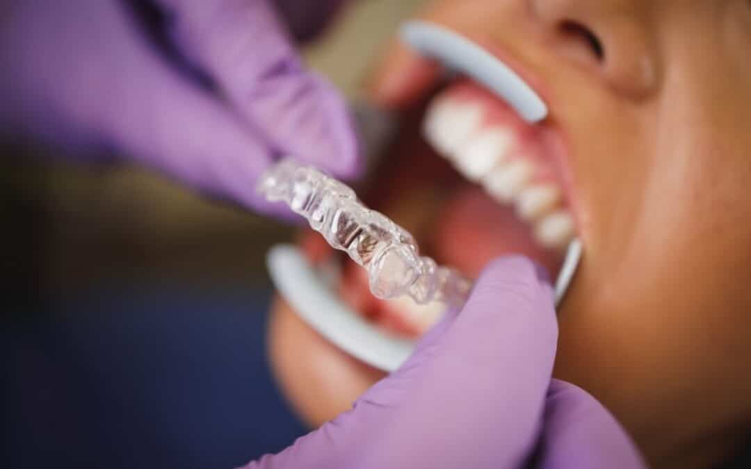 invisalign placement on lower teeth
