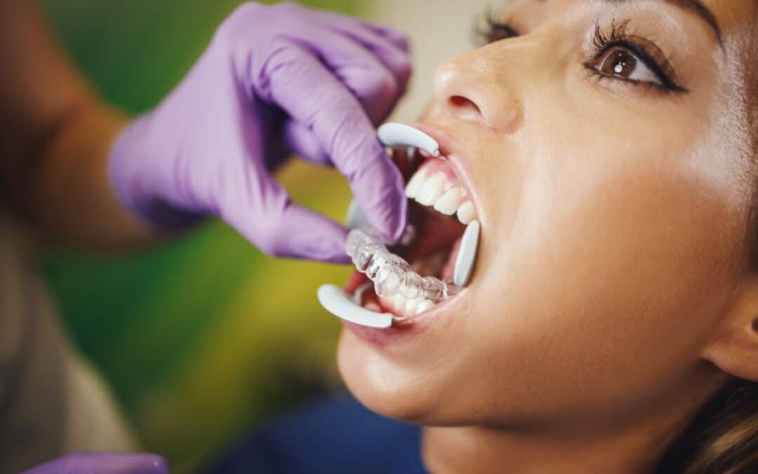 Woman starting Invisalign with veneers on